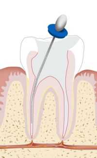 Endodontologie Wurzelkanalreinigung - Dr. Gordon Schroeder - Zahnarztpraxis Dr. Gordon Schroeder in Lengerich & Ladbergen