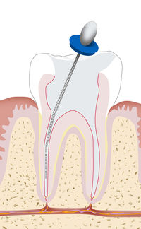 Endodontologie Wurzelkanalreinigung - Dr. Gordon Schroeder - Zahnarztpraxis Dr. Gordon Schroeder in Lengerich & Ladbergen