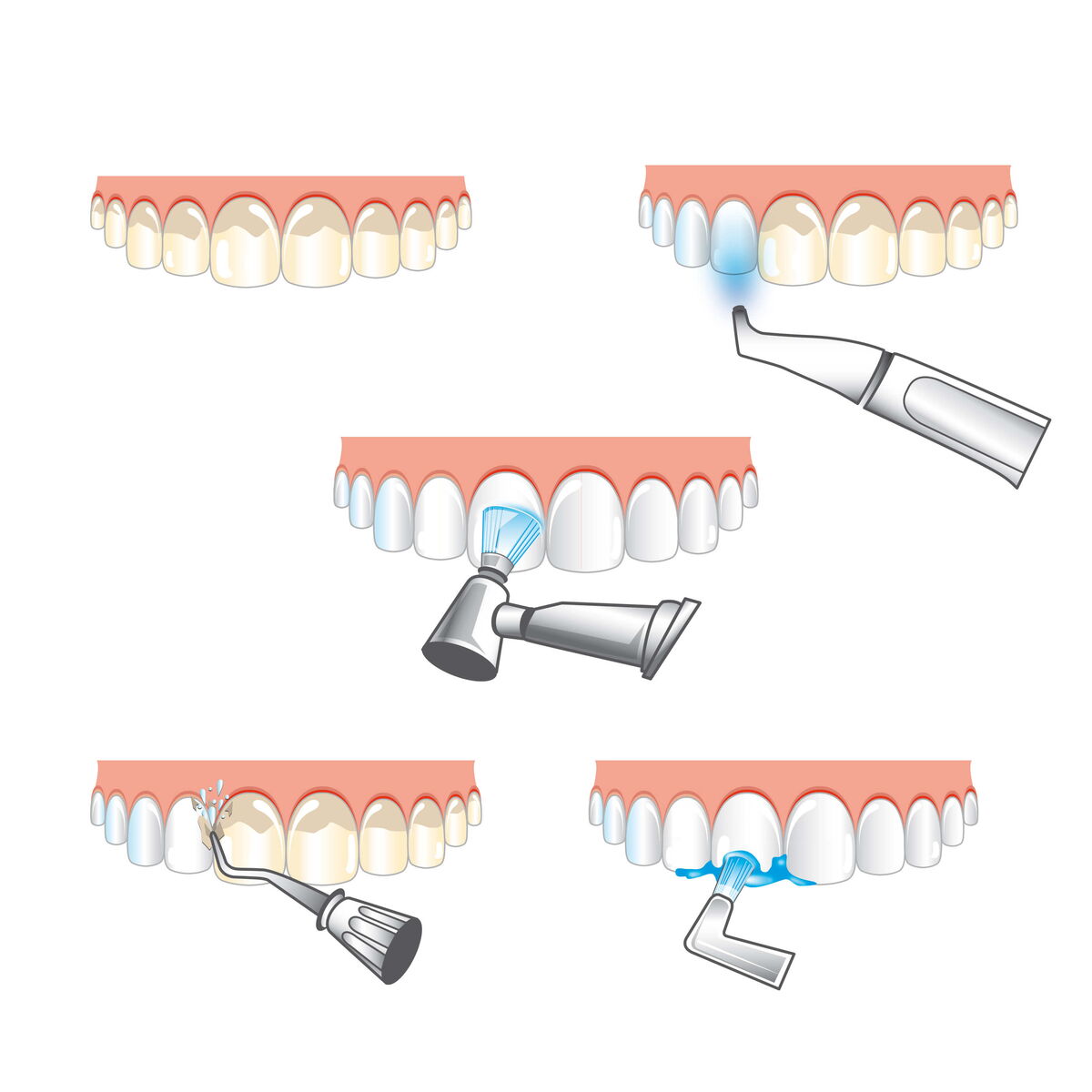 Professionelle Zahnreinigung