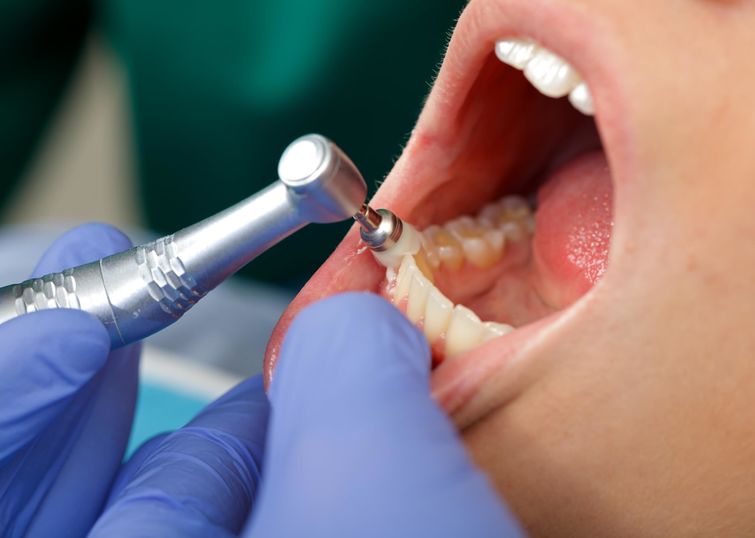 Zahnreinigung Prophylaxe - Dr. Gordon Schroeder - Zahnarztpraxis Dr. Gordon Schroeder in Lengerich & Ladbergen
