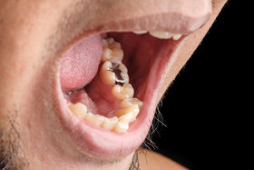 Ästhetische Zahnheilkunde Amalgan - Dr. Gordon Schroeder - Zahnarztpraxis Dr. Gordon Schroeder in Lengerich