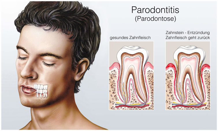 Parodontologie - Dr. Gordon Schroeder - Zahnarztpraxis Dr. Gordon Schroeder in Lengerich & Ladbergen
