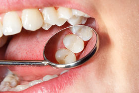 Ästhetische Zahnheilkunde Komposite - Dr. Gordon Schroeder - Zahnarztpraxis Dr. Gordon Schroeder in Lengerich
