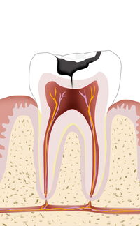 Endodontologie Wurzelkanäle - Dr. Gordon Schroeder - Zahnarztpraxis Dr. Gordon Schroeder in Lengerich & Ladbergen