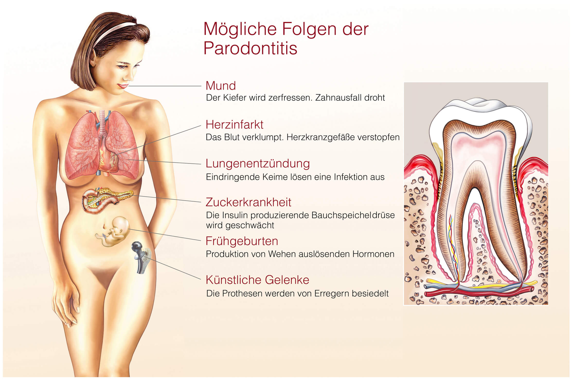 Parodontitisfolgen- Dr. Gordon Schroeder - Zahnarztpraxis Dr. Gordon Schroeder in Lengerich & Ladbergen